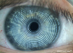 Eye Scan for Dry Eye - Sparks & Feros Optometrists